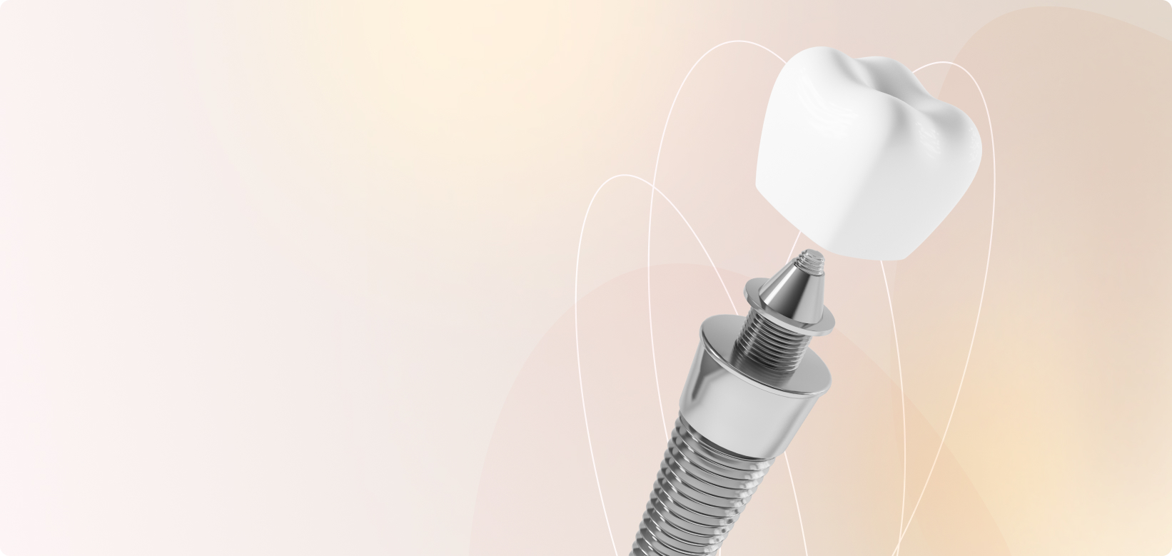 Протез по технологии <nobr>All-One-4</nobr>